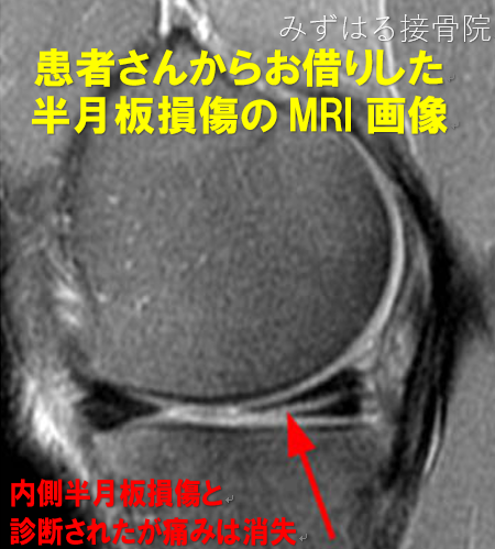 半月板損傷の治療 膝 股関節痛専門 みずはる接骨院 弥富 愛西 蟹江 桑名 半月板損傷の治療 膝 股関節痛専門 みずはる接骨院 弥富 愛西 蟹江 桑名